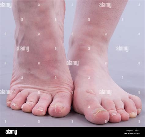 ugly feet pics|334 Images Of Ugly Feet Stock Photos & High.